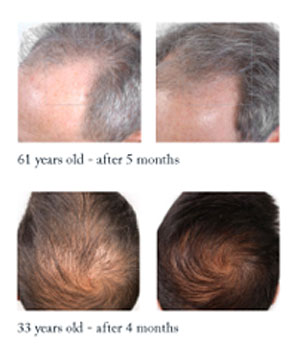 nutrafol restoration hair testimonials